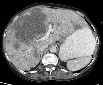Figure 1: large gallbladder fossa mass replacing the entire gall bladder. Discrete liver secondaries can be seen.